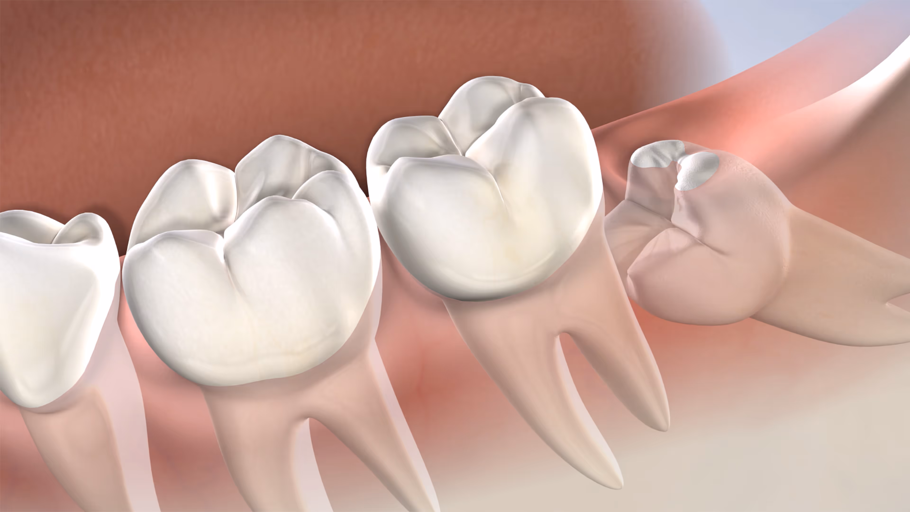 instruction  wisdom teeth