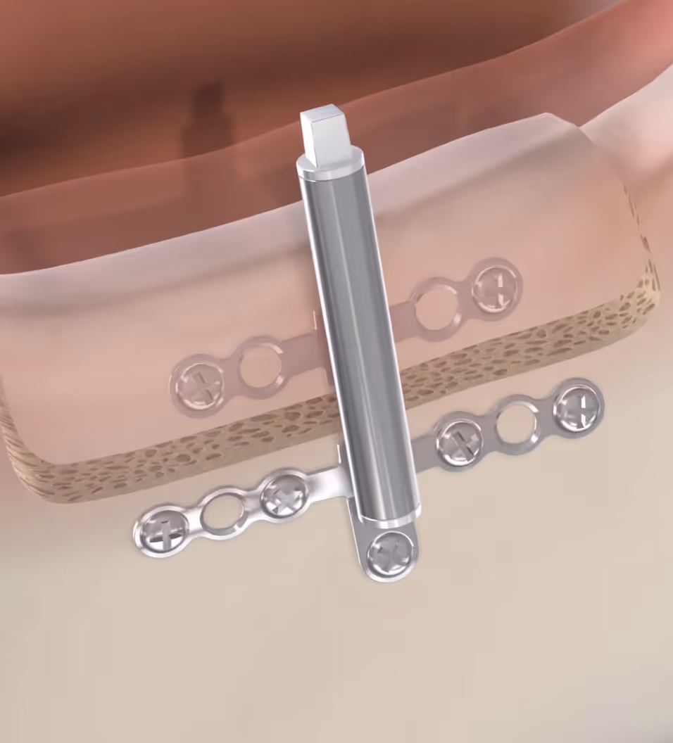 query  distraction osteogenesis