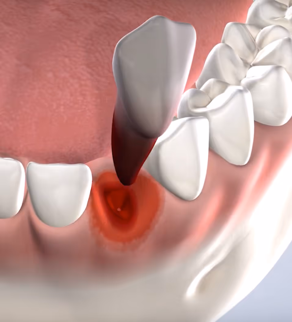 query  tooth extraction