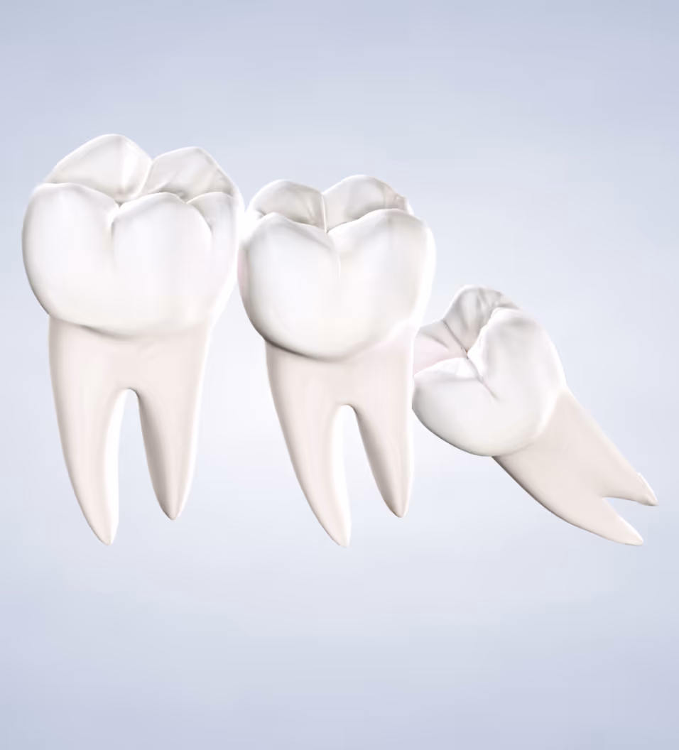 query  wisdom teeth removal