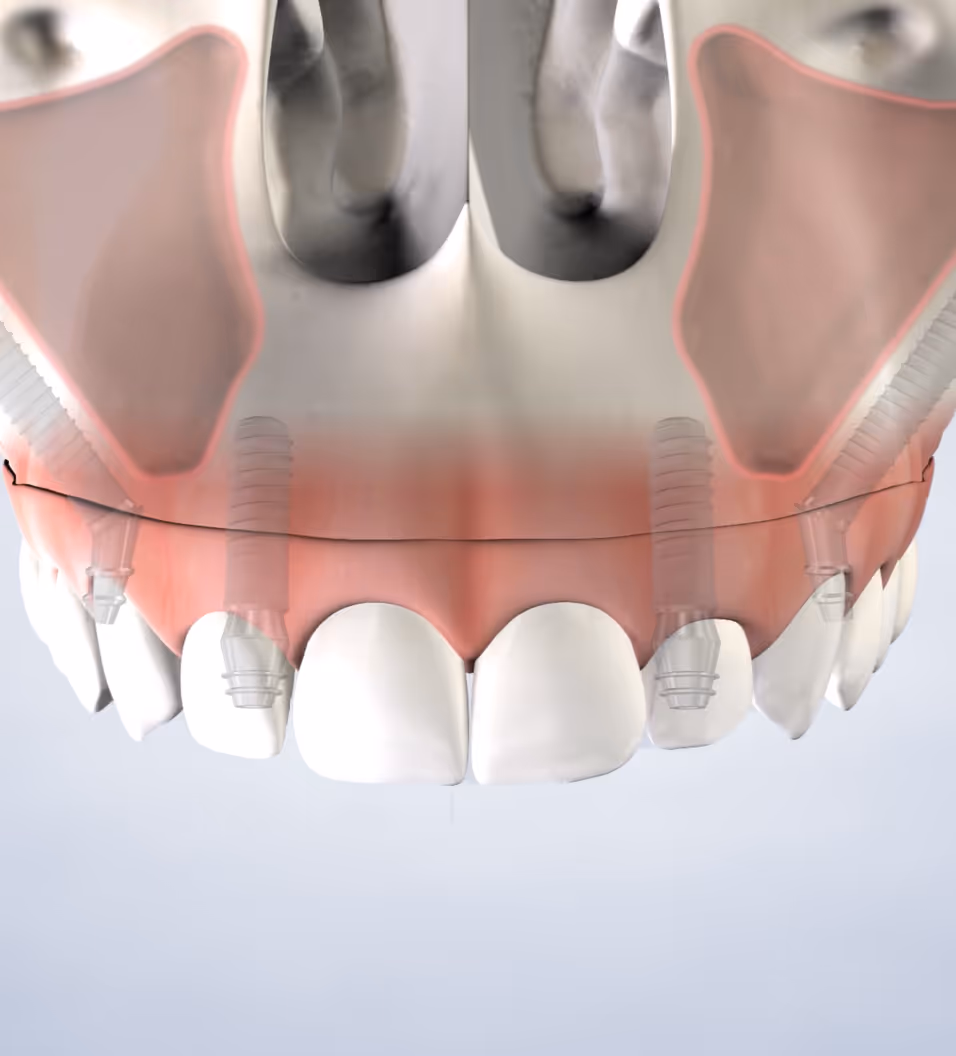 Query  zygomatic