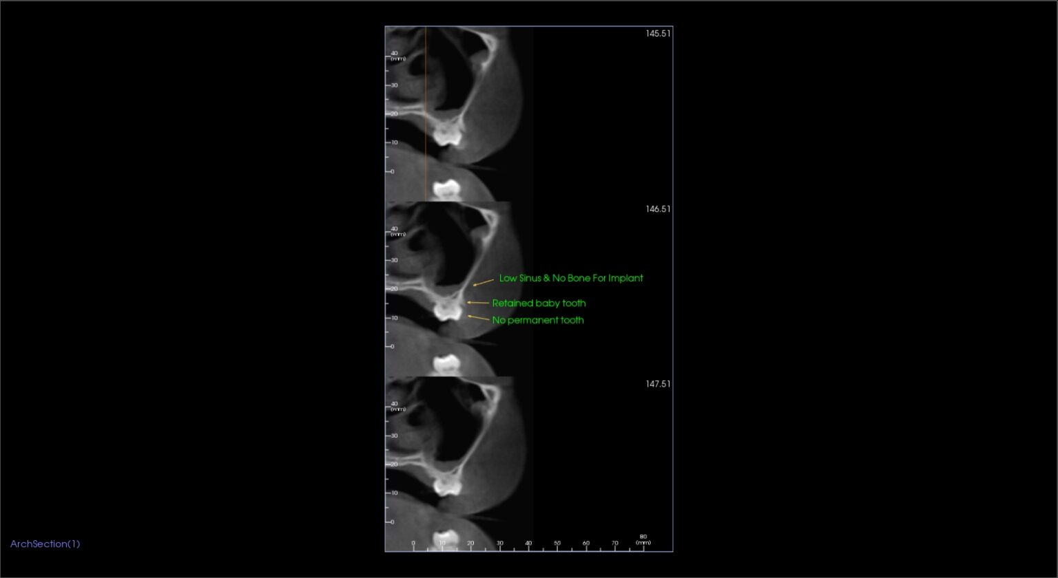 29 Sinus Floor Bone Graft Before Treatment Note retained baby teeth