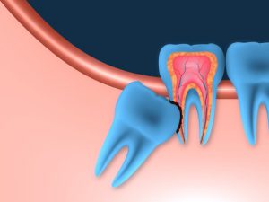 impacted wisdom tooth