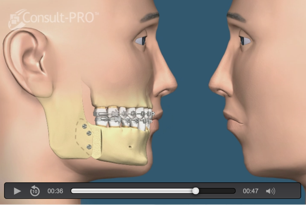 Jaw Surgery Naperville IL Orthognathic Surgery Bite Correction
