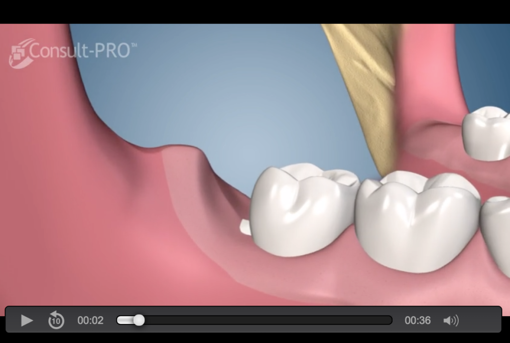 Impacted Wisdom Teeth Removal Cost Without Insurance